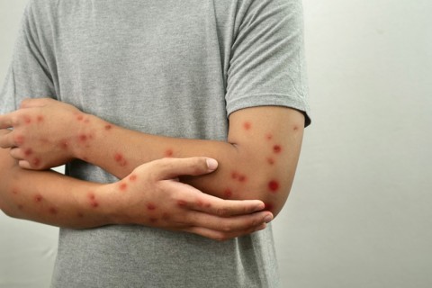 Manaus já tem mais casos de Mpox em 2025 do que em todo o ano passado